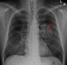 Lancet Oncol：科学家发现新的肺癌预测模型