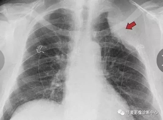 肺 尖 部 胸膜 肥厚