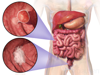 Gastroenterology：<font color="red">霍乱</font>疫苗可降低结直肠癌患者死亡风险