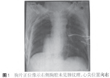 右下肺癌切除术后心脏向右移位1例报