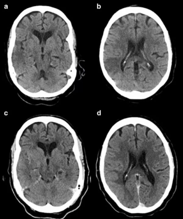 Neuroradiology：“CT模糊效应”也可见于<font color="red">卒</font><font color="red">中</font>早期