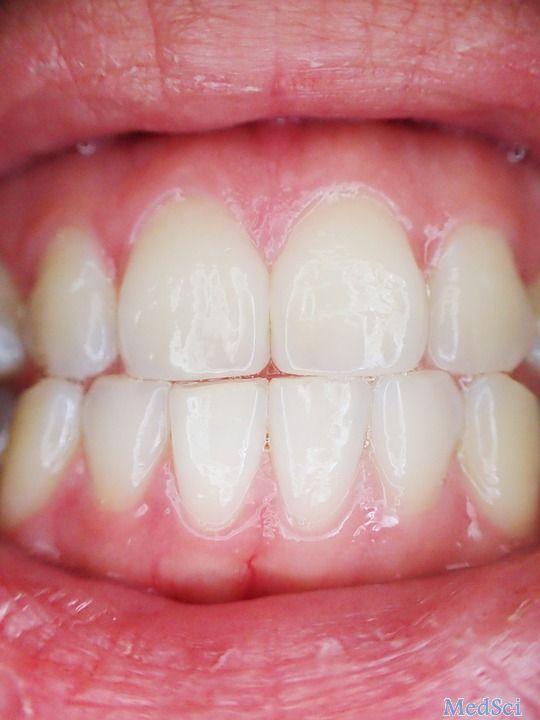 J Clin Periodontol：牙周健康的成年人中，接触位点和<font color="red">龈乳头</font>之间的关系