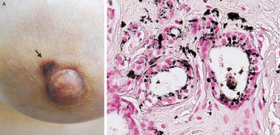 NEJM:色素斑-浸润性乳腺癌的皮肤表现-病例报道