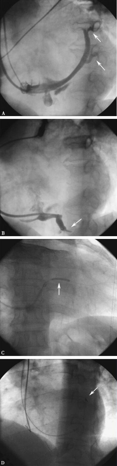 心脏静脉狭窄患者手术一波三折 电极导线断裂怎么办？
