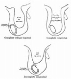 Anesth Essays Res：腹股沟疝修补术中脊髓麻醉和椎旁神经阻滞的比较