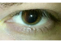 Sci Rep：Norrin保护视神经轴突免受青光眼病变引起的退化影响！