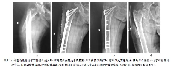 股骨转子下骨折术后骨髓炎新发股骨颈骨折1例