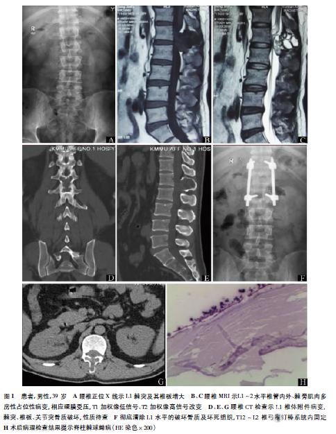 脊柱棘球蚴病1例