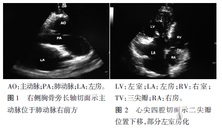 右位心完全性大动脉转位伴二尖瓣下移超声表现1例