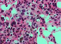 CLIN CANCER RES：HER2阳性乳腺癌T-DM1<font color="red">获得性</font><font color="red">耐药</font>与Cyclin B1诱导缺陷