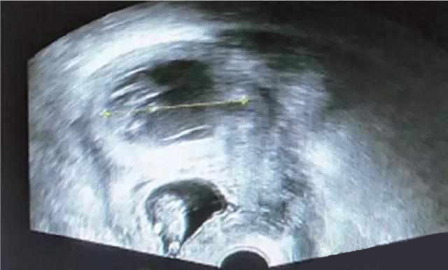 剖宫产术后子宫瘢痕合并宫角<font color="red">双</font>胎异位妊娠一例