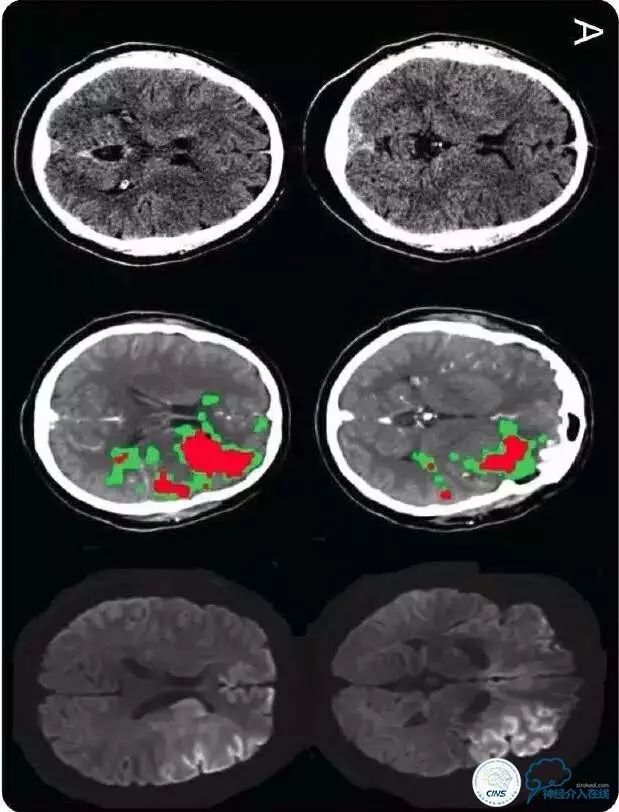 Neurology：ASPECTS评分和CT灌注哪一个更精确？