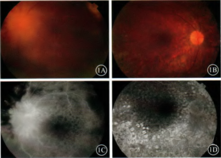 原发性玻璃体视网膜淋巴瘤一例
