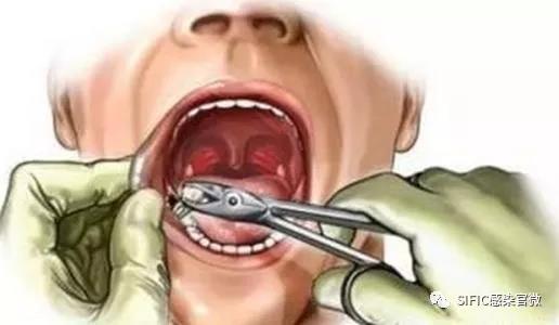 拔牙vs不正确刷牙丨哪种方式更容易得感染性心内膜炎？