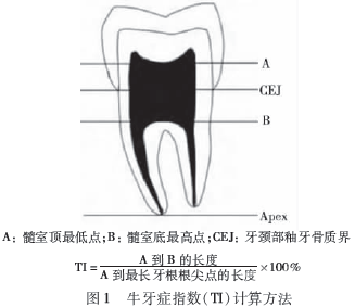 下颌第二前磨牙牛牙症伴<font color="red">畸形</font>中央尖及C型根管1例