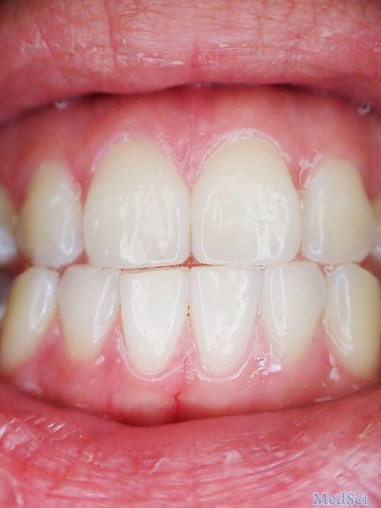 J Periodontal Res：有无<font color="red">牙</font><font color="red">周</font>疾病史患者的牙龈生物型