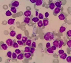病例分享：淋巴浆细胞淋巴瘤/华氏<font color="red">巨球蛋白</font>血症？一例分析