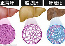 Hepatology：非酒精性脂肪性肝病的诊断新<font color="red">模式</font>！