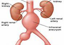 Kidney int：C5a受体1在抗<font color="red">髓</font>过氧化物酶肾小球肾炎中的重要作用！