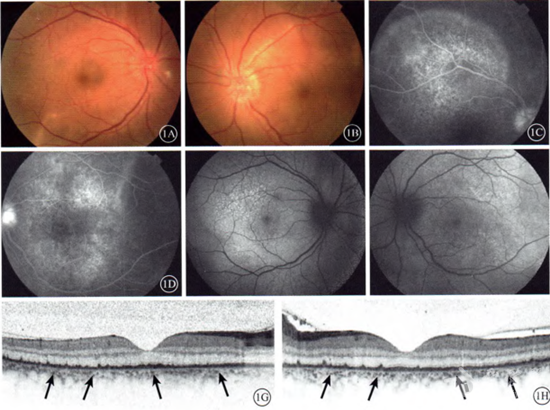 双眼急性梅毒性后部鳞状脉络膜视网膜炎1例