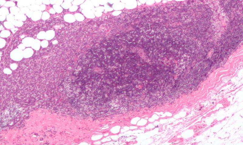 PNAS:乳腺癌治疗的新方法“免疫<font color="red">激活</font>细胞因子”