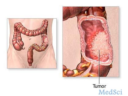Gastroenterology：炎性<font color="red">饮食</font>与结直肠癌的分型有关