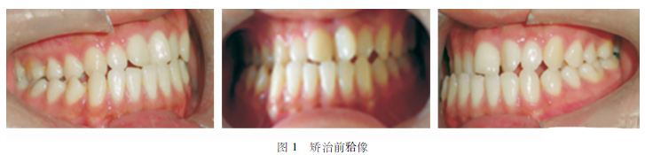 远移下颌磨牙矫治反牙合伴下颌偏斜1例
