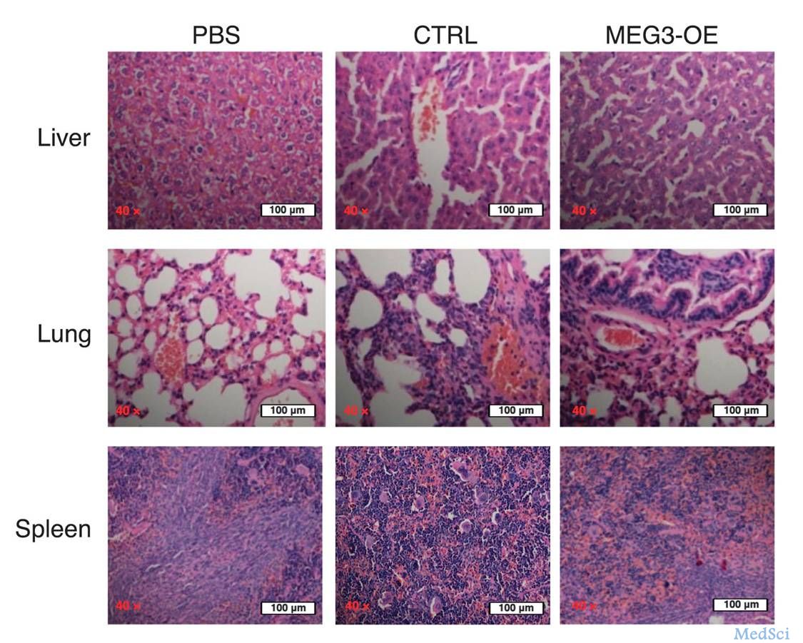 Leukemia：科学家发现WT1-MEG3信号通路有望成为治疗AML的新靶点