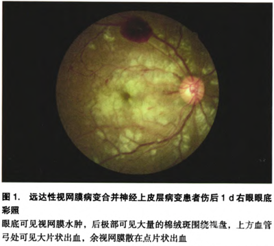 远达性视网膜病变合并神经上皮层病变一例