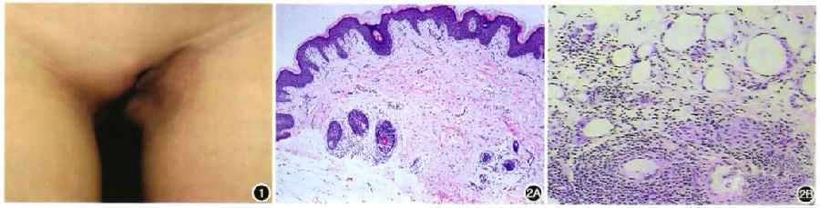 Graves病合并脂肪萎缩性脂膜炎一例