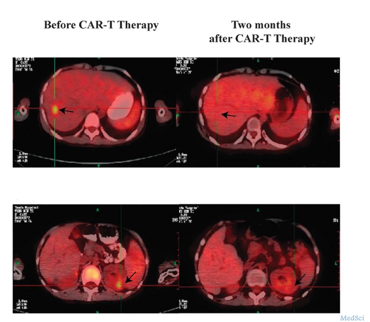 Leukemia：CD19靶向的CAR-T细胞有望安全有效的治愈难治性<font color="red">复发性急性</font>B淋巴细胞白血病！