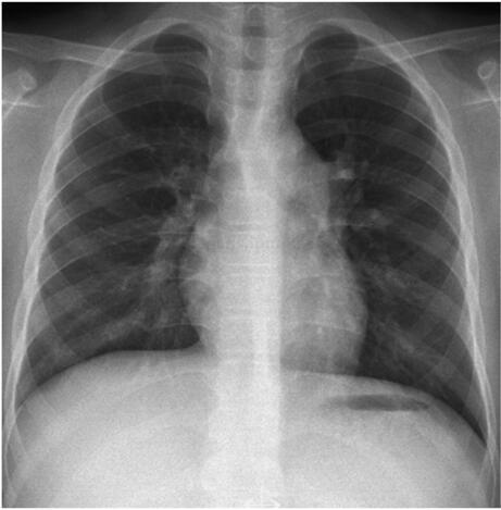 肺动脉瓣狭窄球囊扩张术后仍有轻度收缩期杂音 正常吗？