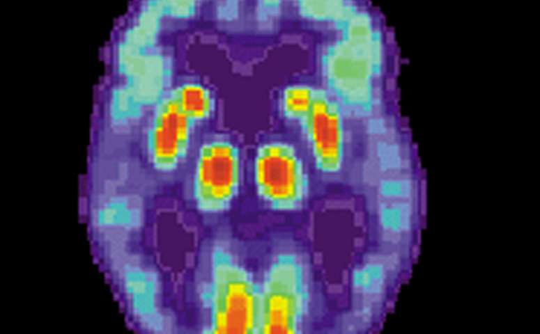 Brain：脑影像学进展确定阿兹海默症<font color="red">传播发展</font>的关键蛋白，老年痴呆有救了