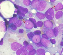 Leukemia：<font color="red">LSD1</font>有望称为治愈MDS相关白血病的靶点！