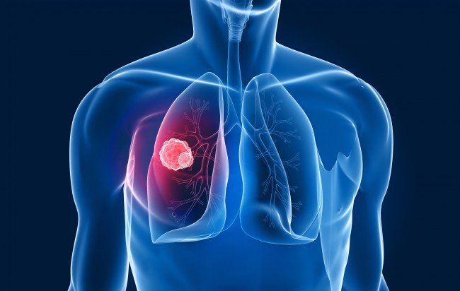 FDA批准阿法替尼治疗罕见肺癌