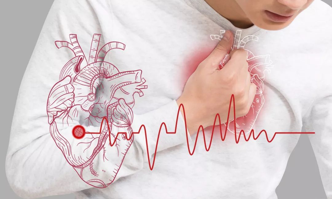 心血管内科病例赏析——心肌梗死后频发室速