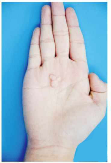 手掌孤立性胶原瘤1 例