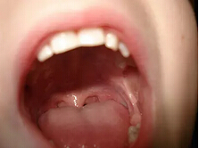 J Transl Med：复合非脱矿质<font color="red">异</font>种牙本质与β-磷酸三钙可有效修复牙槽突裂