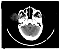 面部鲍温病伴多形性恶性纤维组织细胞瘤1例