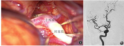 三干型大脑中动脉分支闭塞残端表现为分叉部动脉瘤的诊治一例