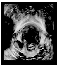 盆底超声诊断肛提肌胃肠道外间质瘤1例