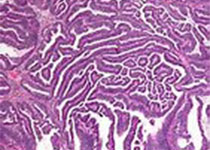 鼻嗜酸性细胞乳头状瘤二例