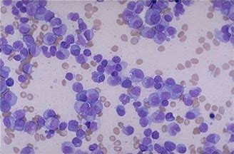 Leukemia：<font color="red">DNMT</font>3A突变的转录水平并不能预测急性髓系白血病患者的结局