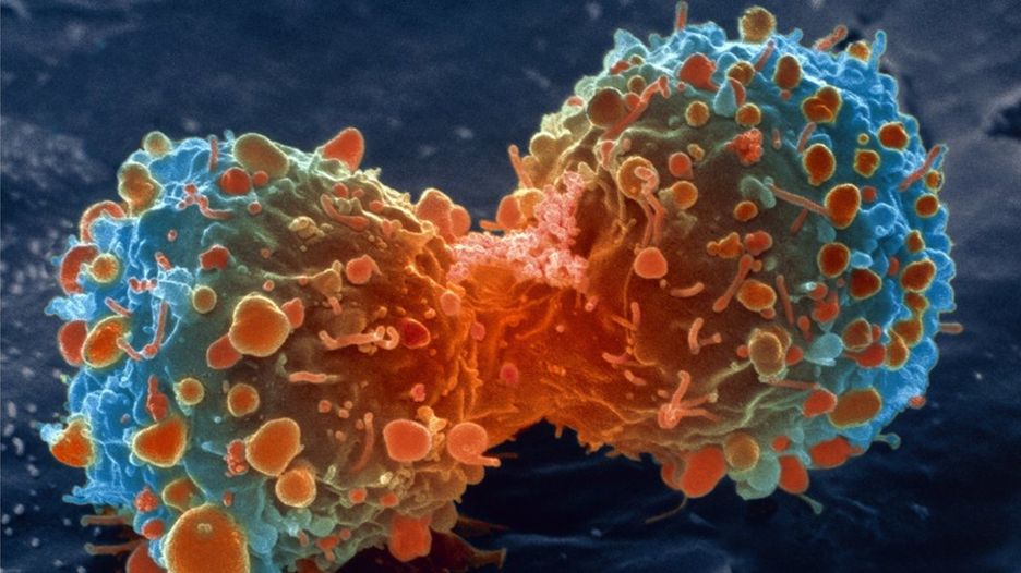J Clin Invest：饿死癌细胞并非“空穴来风”，科学家确定能够饿死癌细胞的新靶点