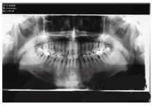 正畸-修复联合治疗上前牙间隙一例
