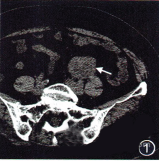 卵巢静脉<font color="red">平滑肌</font>肉瘤影像表现一例