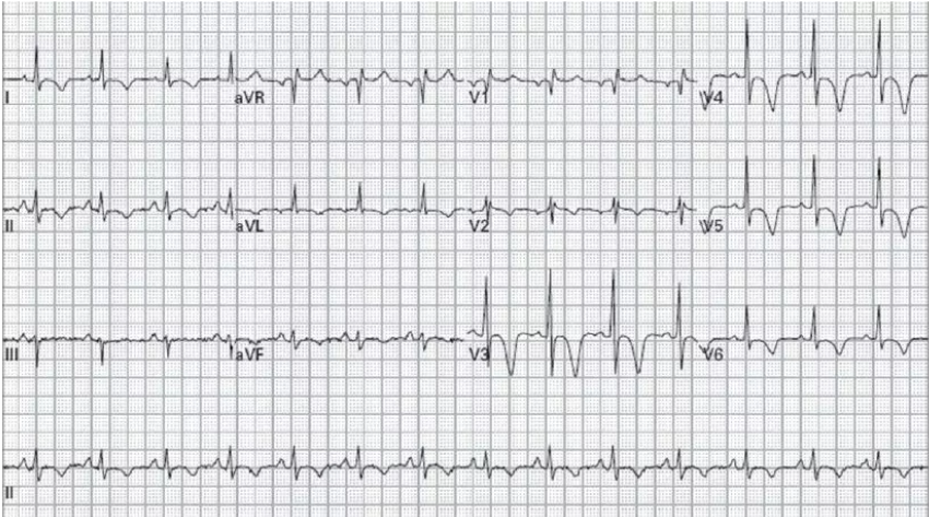心电图3s征诊断标准图片