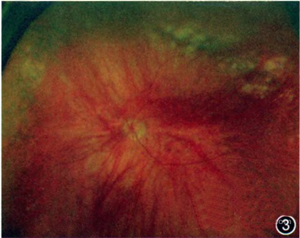 白化<font color="red">病</font>合并复发性视网膜脱离一例