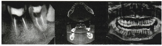 下颌牙根尖孔外器械断针取出1例