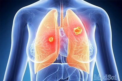 研究人员找到治疗晚期肺癌的新策略
